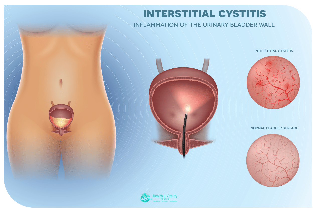 Interstitial Cystitis (IC)