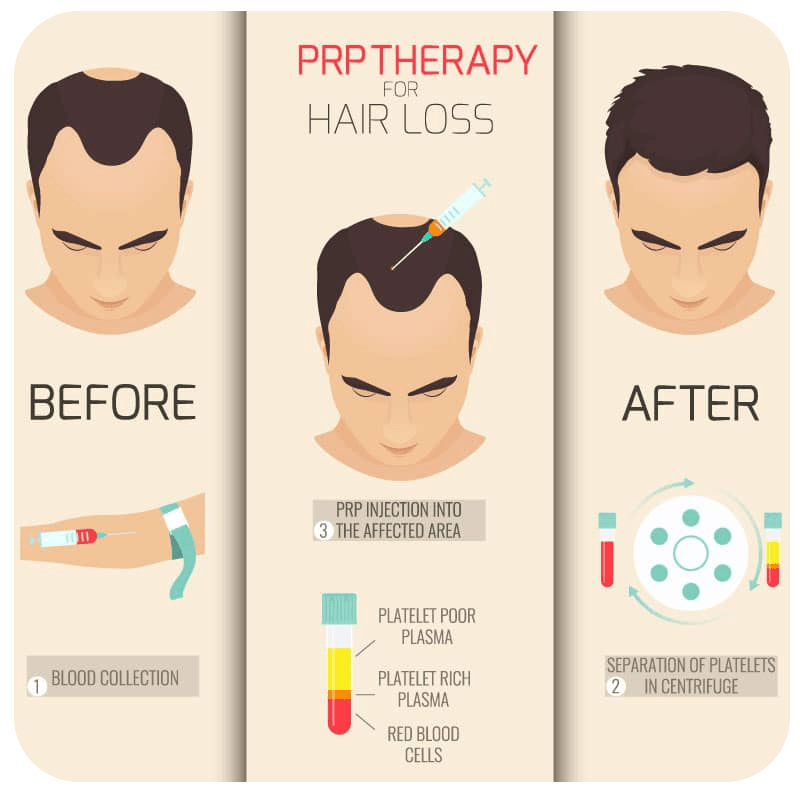 Scalp PRP for Hair Growth - Platelet-Rich Plasma - Dr Lalezar