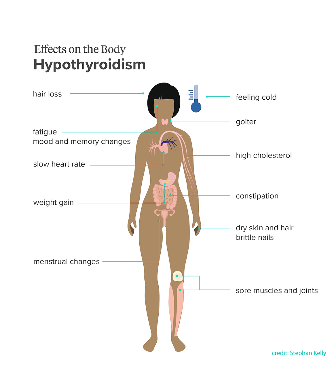 Hypothyroidism (Underactive Thyroid)