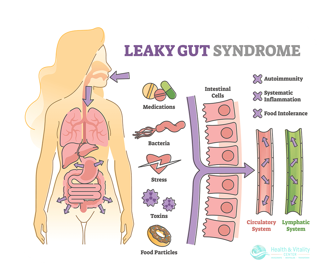 Want to Heal a Leaky Gut? Get Expert Help From Dr. Lalezar
