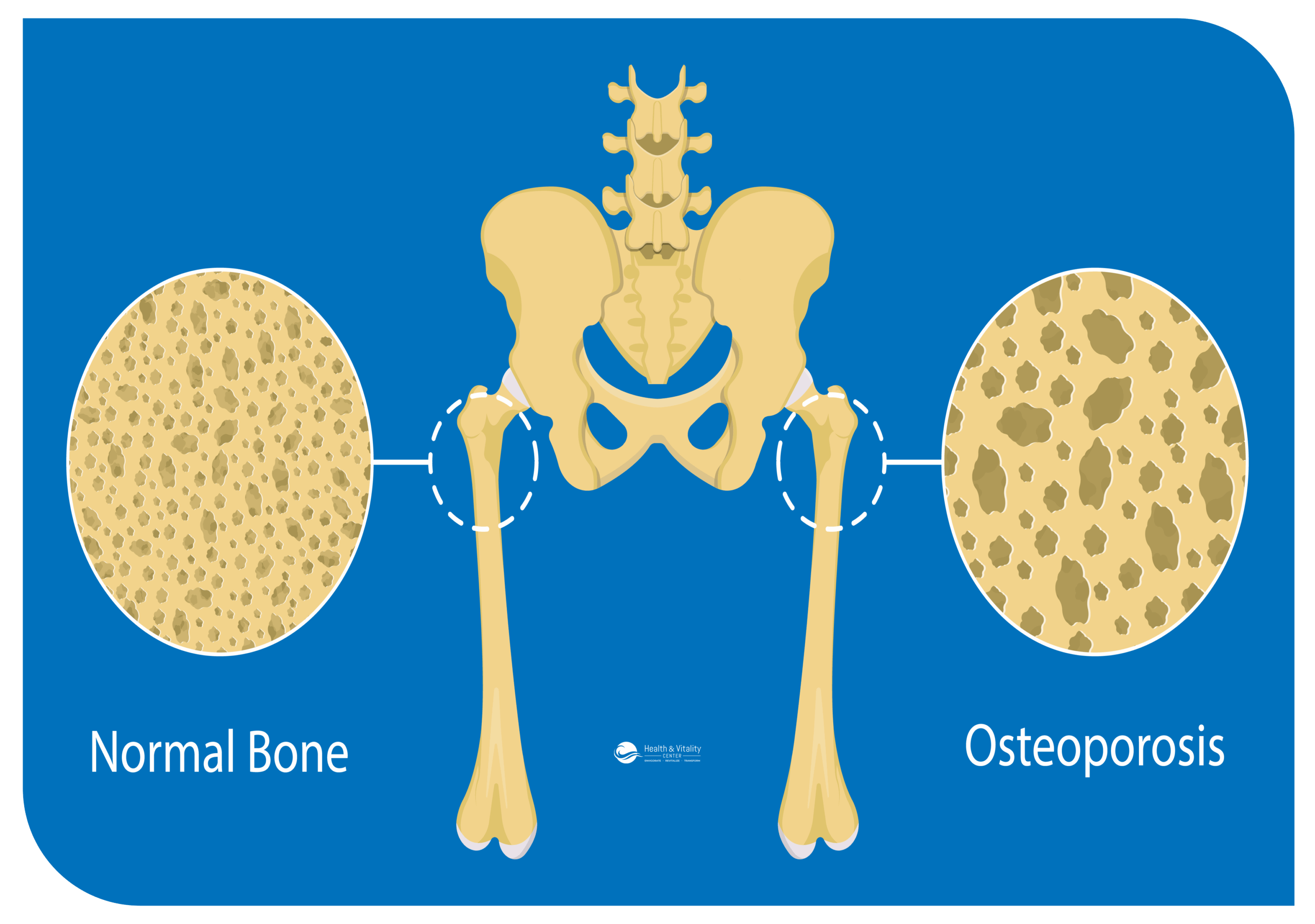 Osteoporosis (bone tissue and bone mass decline)