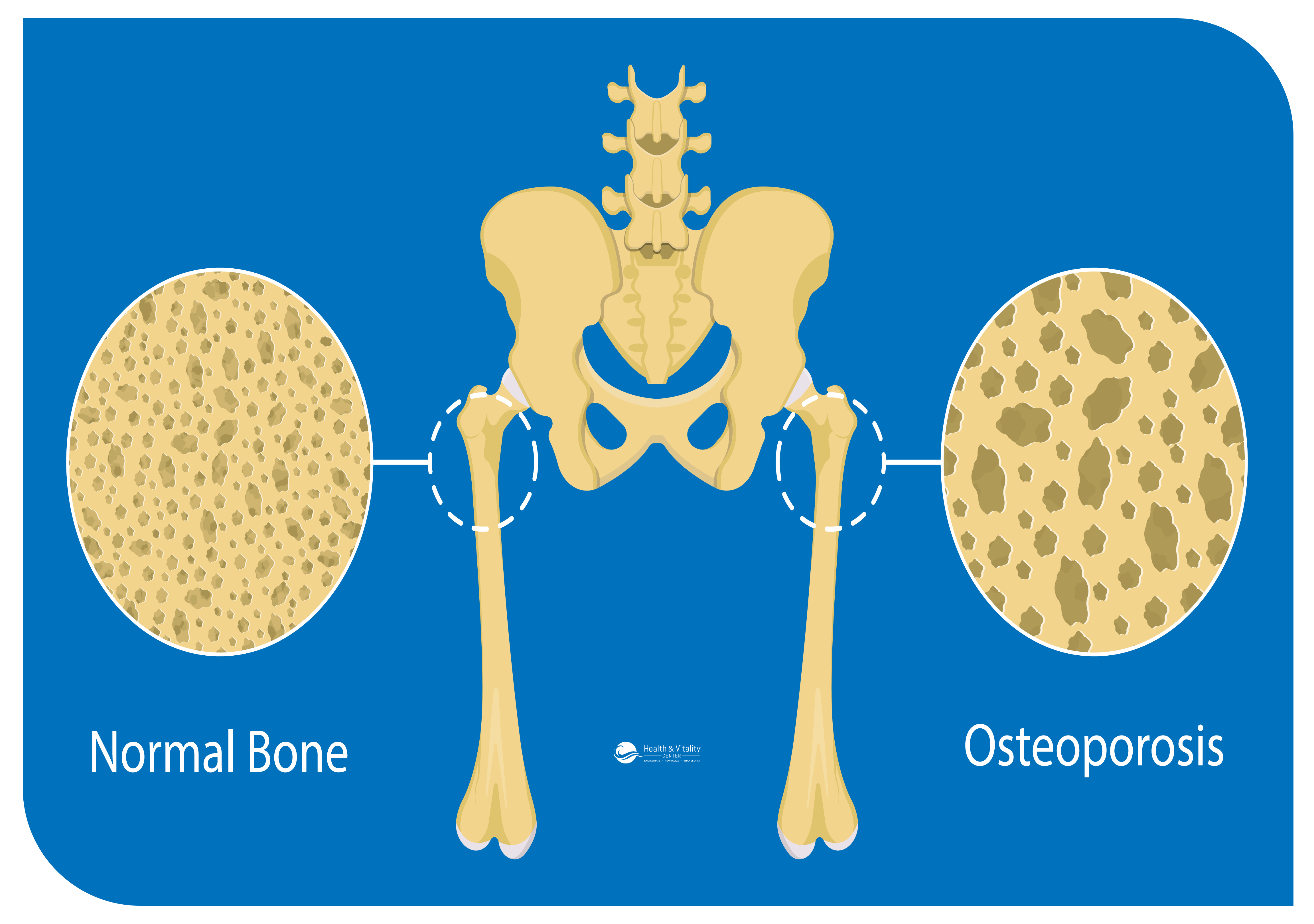 Osteoporosis (bone tissue and bone mass decline)
