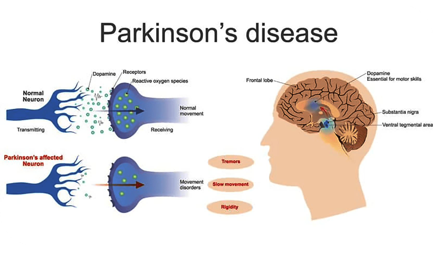 parkinsons disease dopamine