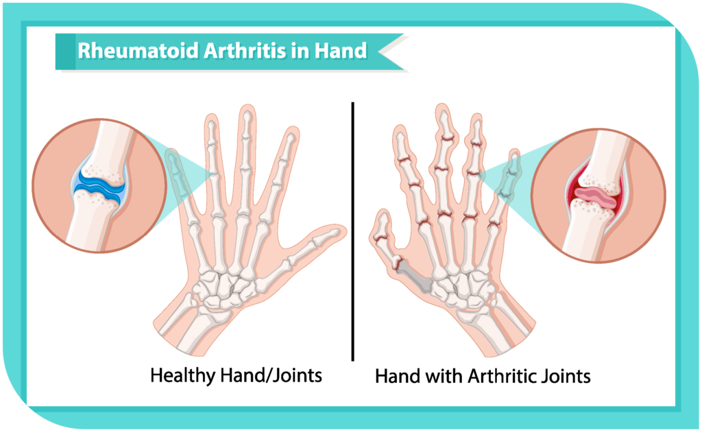 Heal Rheumatoid Arthritis Holistically - Dr. Shiva Lalezar, DO