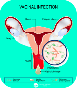 Chronic Bacterial Vaginosis - Holistic Treatment - Dr. Lalezar