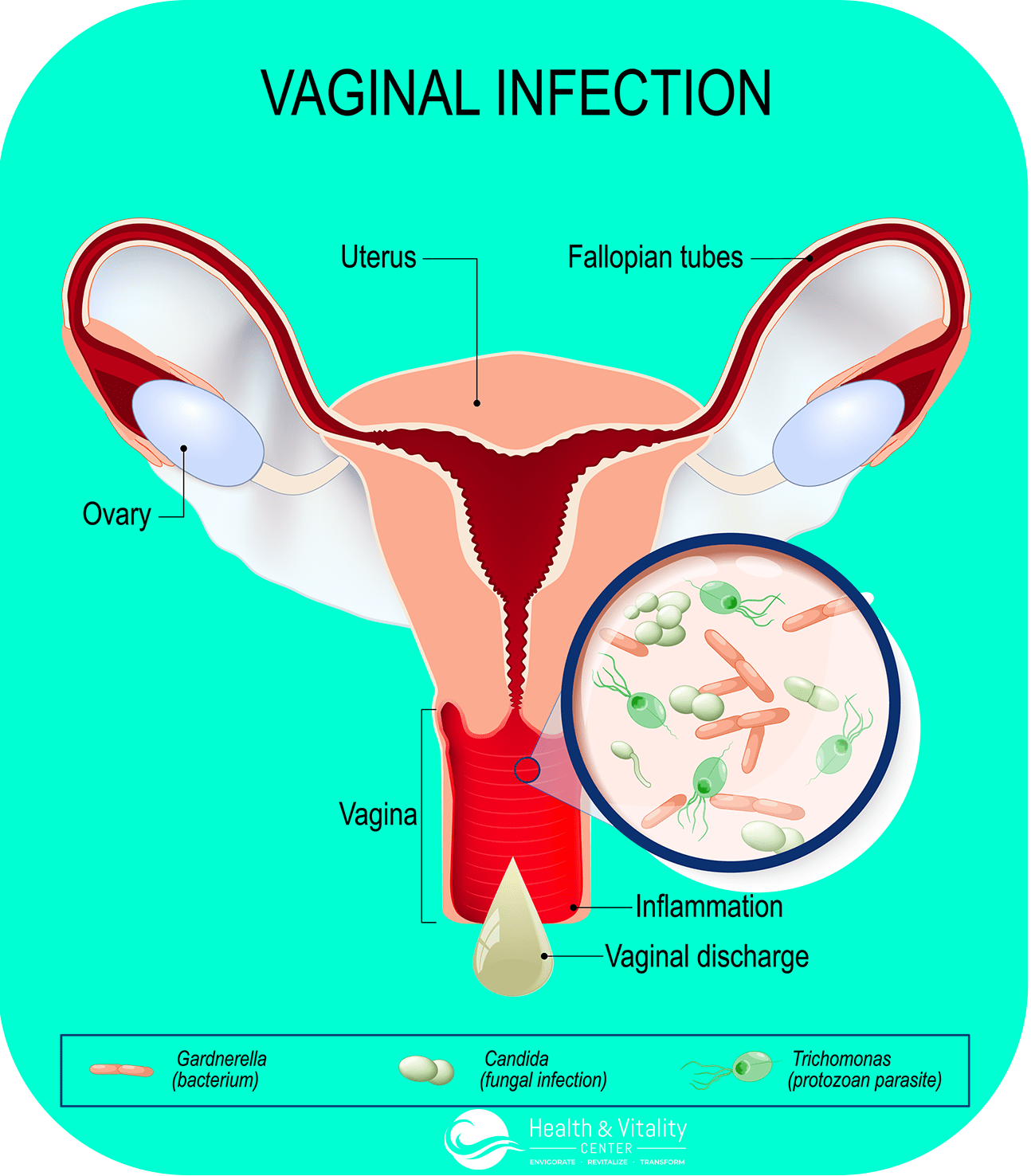 Chronic Bacterial Vaginosis Holistic Treatment Dr Lalezar